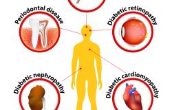 Diabete mellito, trial: Upo e ospedale di Novara cercano volontari