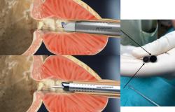 Intervento rivoluzionario alla prostata con mini strumenti e super laser