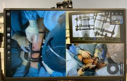 Traumatologia del Sant'Andrea prima in Italia a utilizzare "Skill assist"