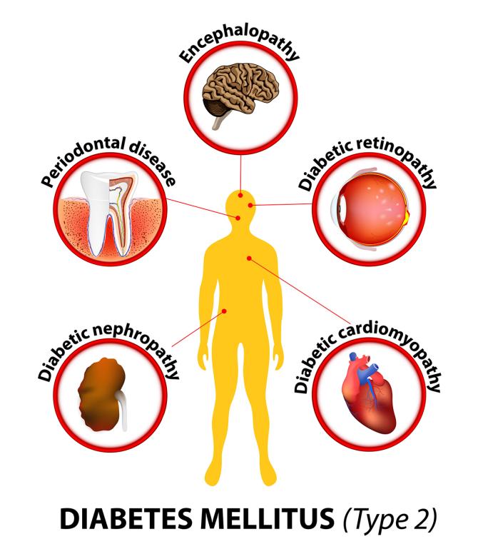 Diabete mellito