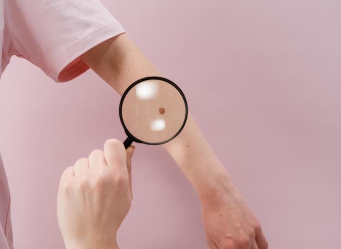 Melanoma